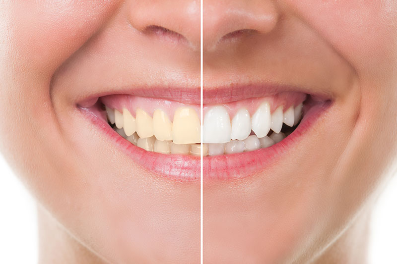 Teeth Whitening in Montebello